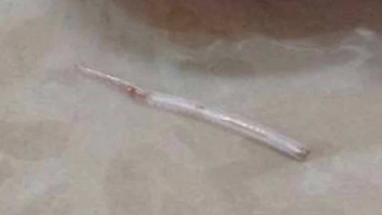 長達近2公分的魚刺卡喉2週,最終從頸部皮膚冒出,被醫師手術取出。(翻攝自thethaiger)