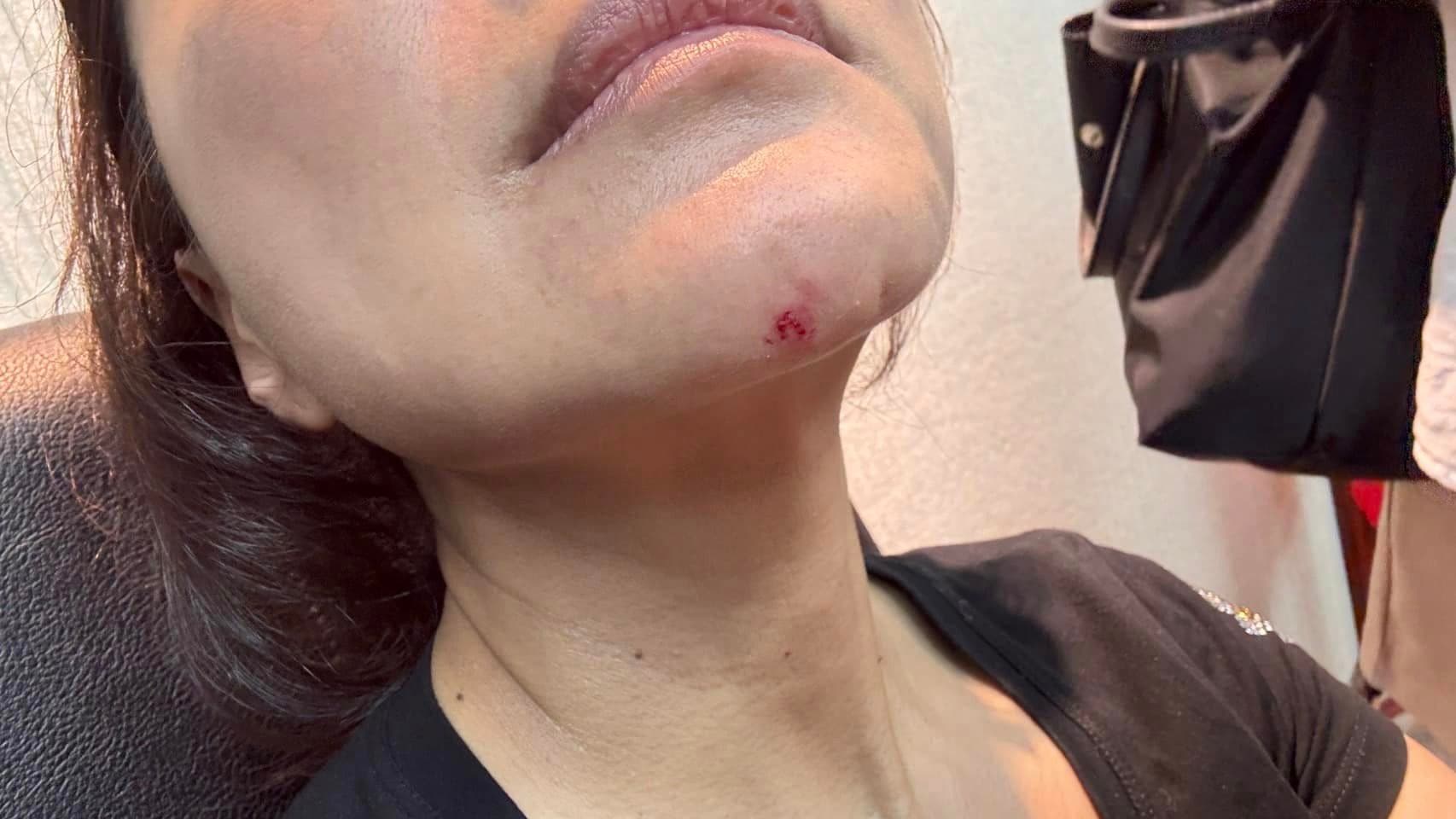 林楚茵被王鴻薇打到下巴都見血。(翻攝自立法委員 林楚茵臉書)