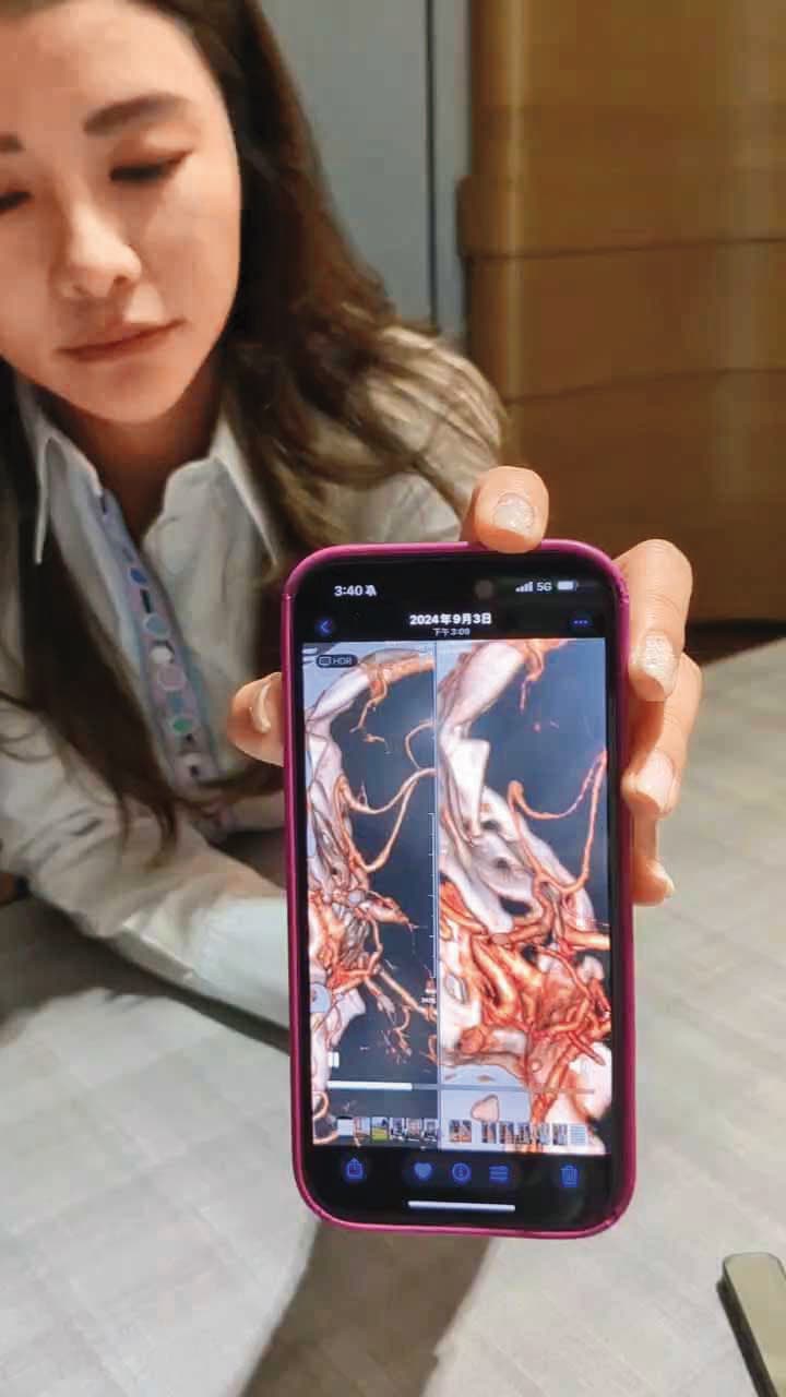 徐培菁說她因顱內長動脈瘤,無法熬夜問訊,偏偏張時嘉都是深夜傳訊她,令她頭痛加劇。手機畫面為腦部動脈瘤X光圖片。