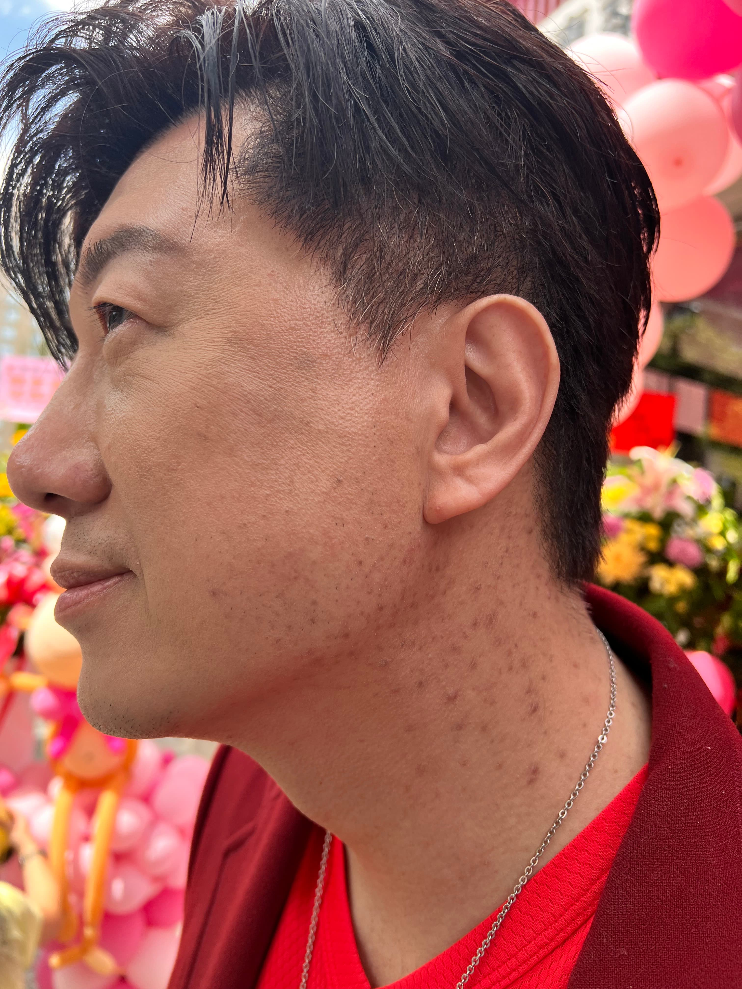 吳皓昇因脖子長期沾到女兒生髮的藥導致大片毛囊炎。(民視提供)