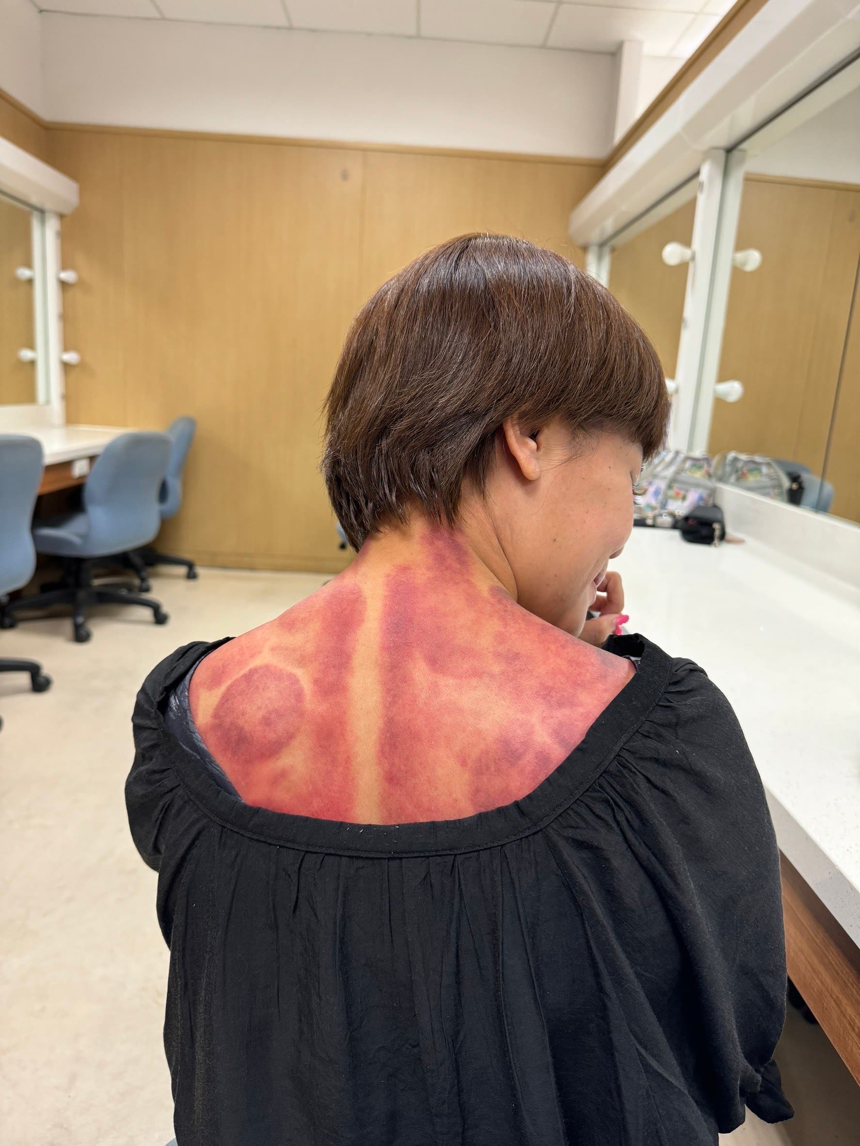 錦雯拍攝《愛的榮耀》熱中暑去刮痧被醫生認出是吳春香。(民視提供)