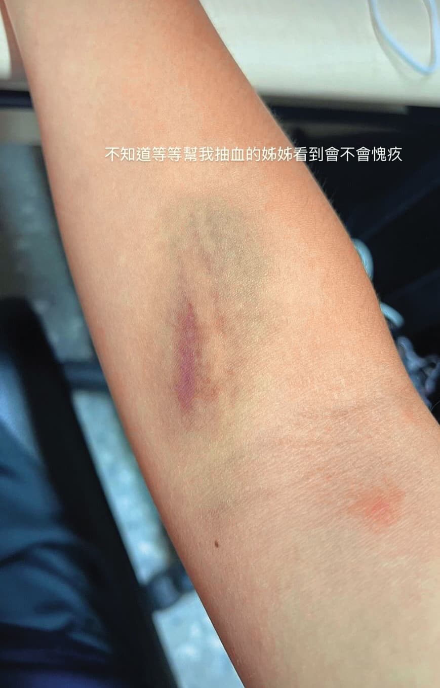 女足隊員簡奇陞手臂抽血處出現大片瘀青,看起來怵目驚心。(翻攝簡奇陞Threads)