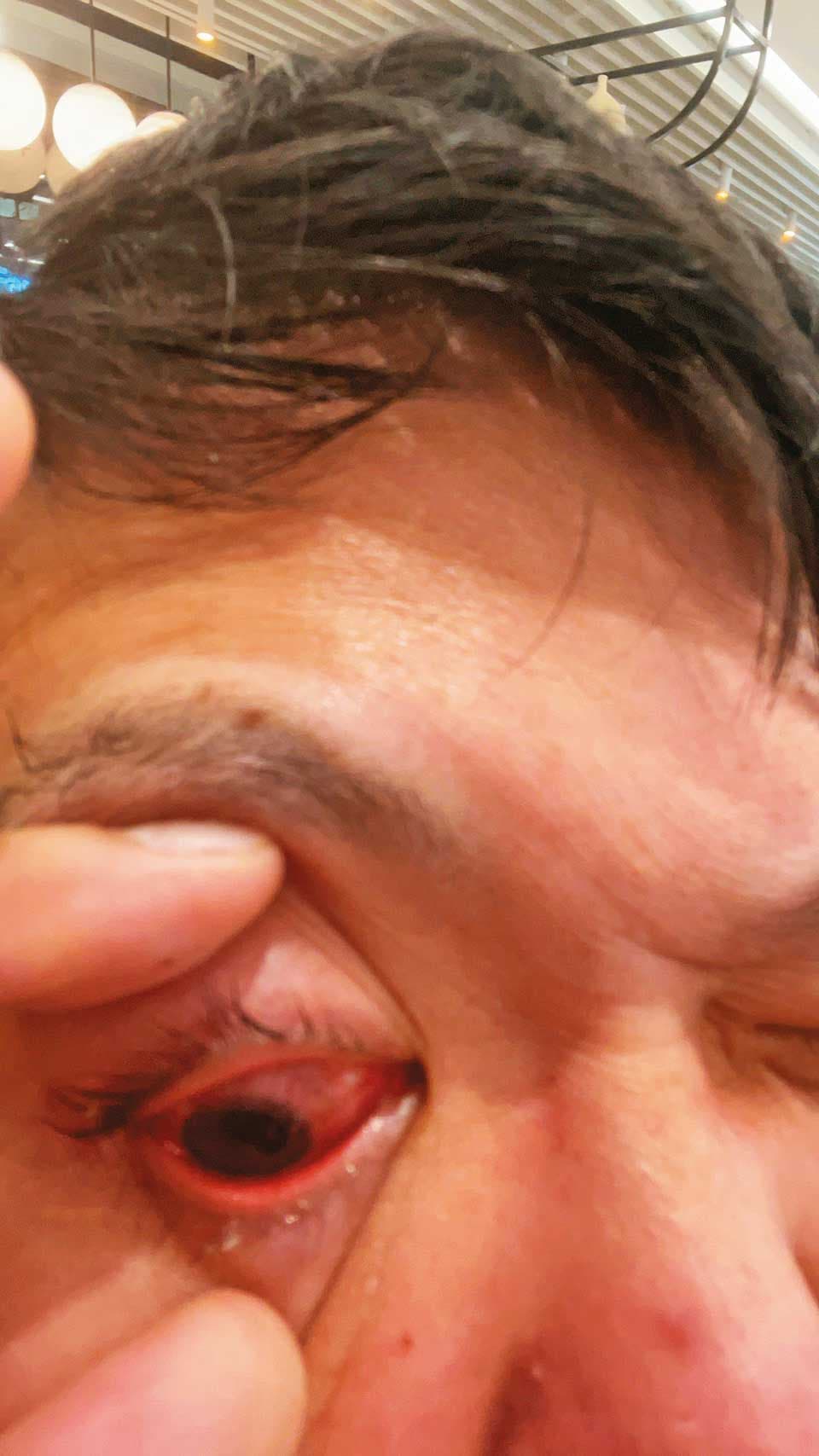 被警方壓制過程中,黃先生的眼角膜破裂受傷。(讀者提供)