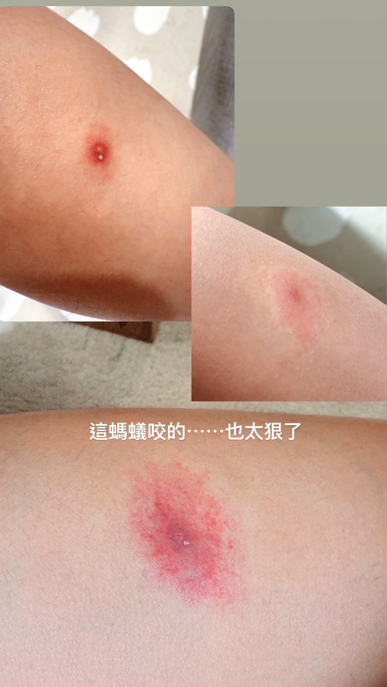 王瞳在山區拍戲時遭紅火蟻鑽褲子叮咬，長出水泡一週後仍紅腫難消。（王瞳提供）