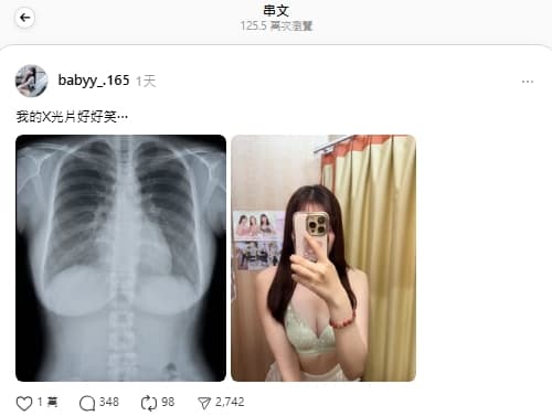 網紅「兔兔」分享X光片照,意外爆紅。(翻攝自Threads)