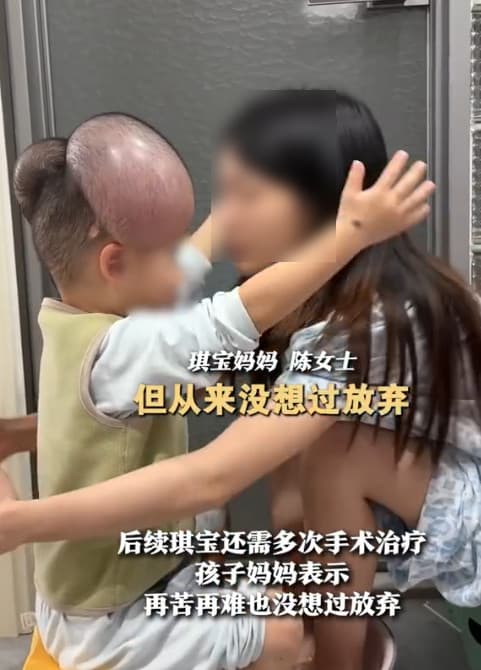 琪寶母親為了治好小孩先天性的巨痣,堅強陪他治療。(翻攝微博)