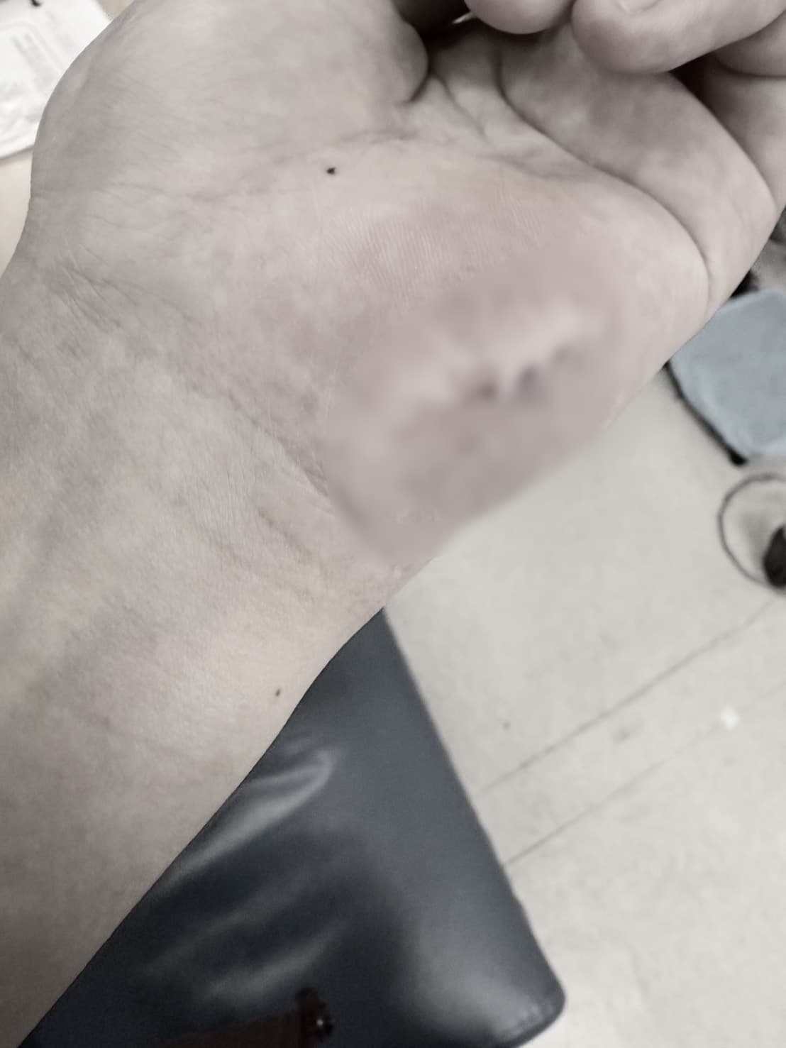 護理師遭病患惡意咬傷左手腕導致韌帶斷裂。(讀者提供;畫面經變色處理)