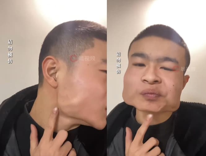 中國一名青少年因長期吃檳榔,導致臉變成方塊臉。(翻攝微博)
