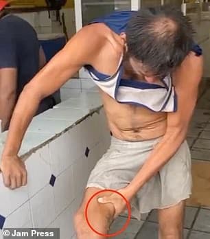 男子腿上疑似有被鱷魚咬過的傷口。(翻自《每日郵報》)