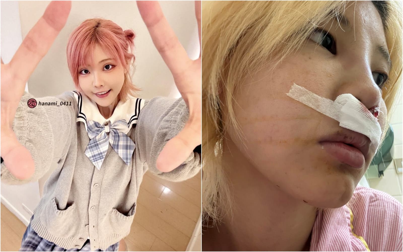 苡琍Hana控訴醫美手術出意外,害她賠了健康還因此無法工作。(翻攝自臉書苡琍 - Hana )
