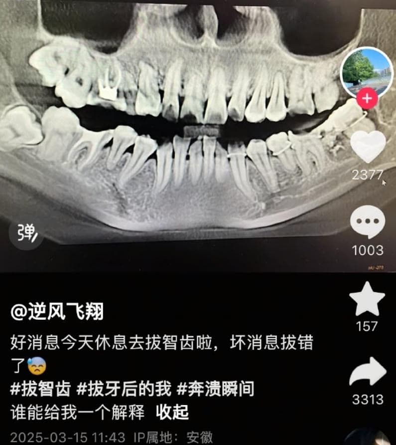 安慶市立醫院一名牙醫幫吳女拔智齒,沒想到拔錯牙後,竟用鐵絲強行綁回。(翻攝微博)