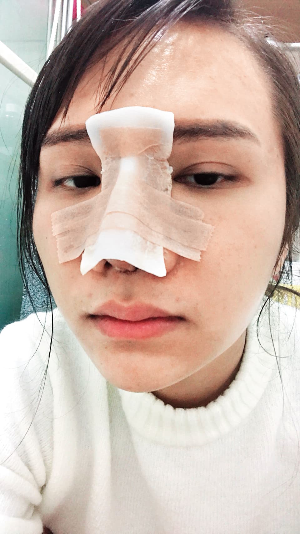 小A辣做完隆鼻手術後恢復中的休養照。(小A辣提供)