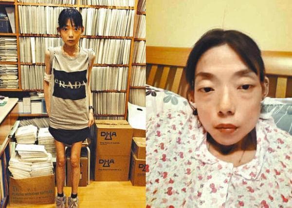 伍智恒在離婚後病情加劇,身高162公分的她更瘦到22公斤。(翻攝自微博)