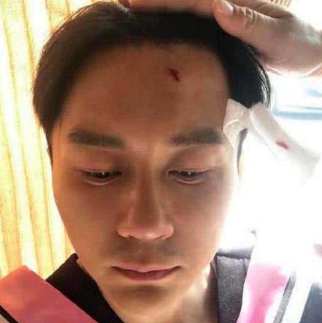 李晨曾在《跑男》摔破頭。(翻攝自李晨微博)