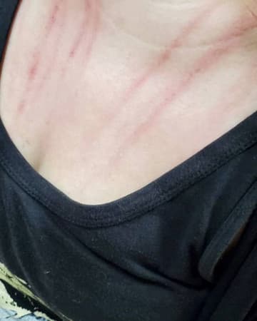 Keanna經紀人指控被莉婭推,曬出胸前抓痕照。(翻攝自Keanna經紀人IG)