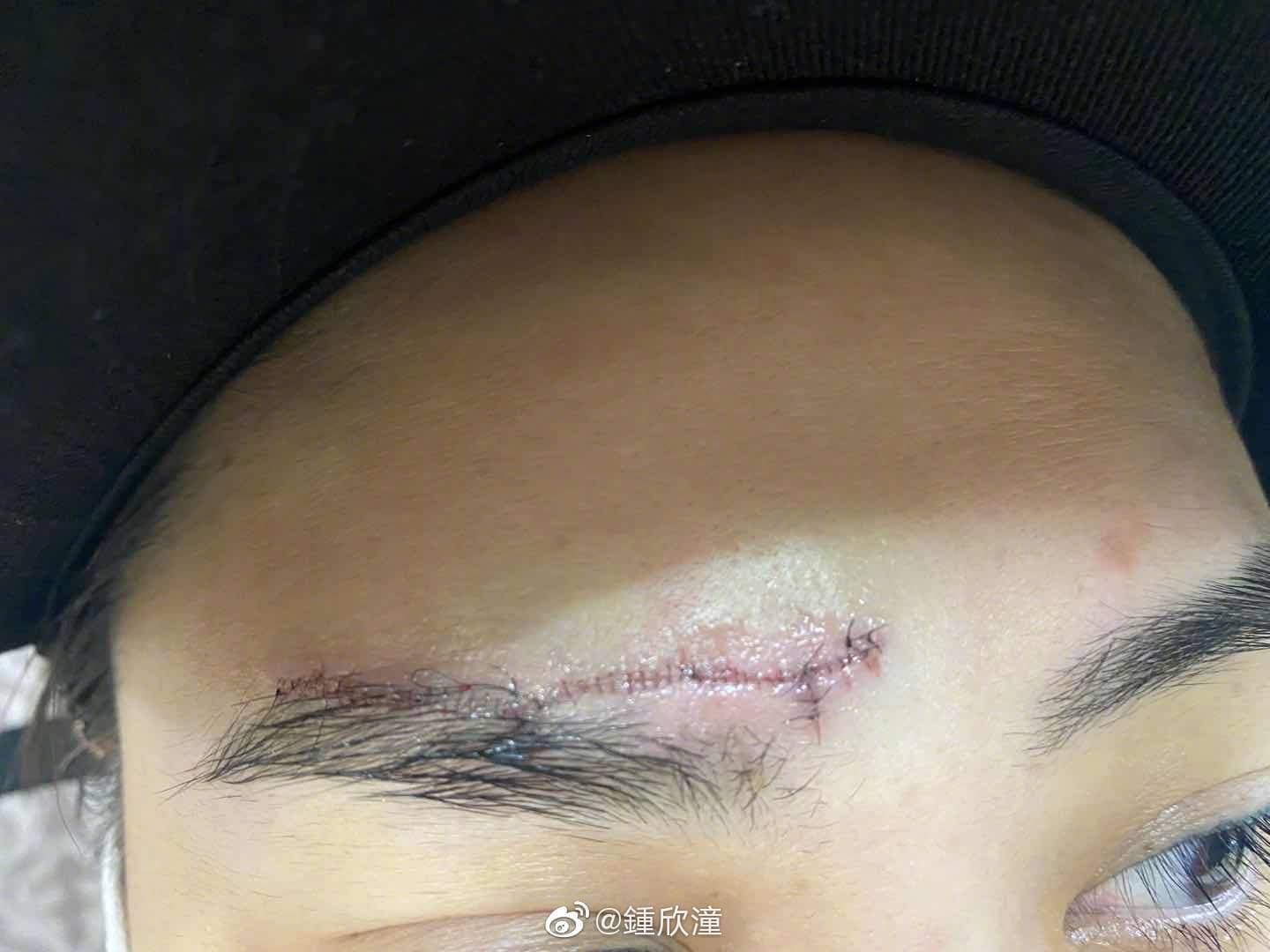 任達華為阿嬌另外介紹整形外科醫生,重新縫合的傷口看來細緻多了,避免日後破相風險。(阿嬌微博)