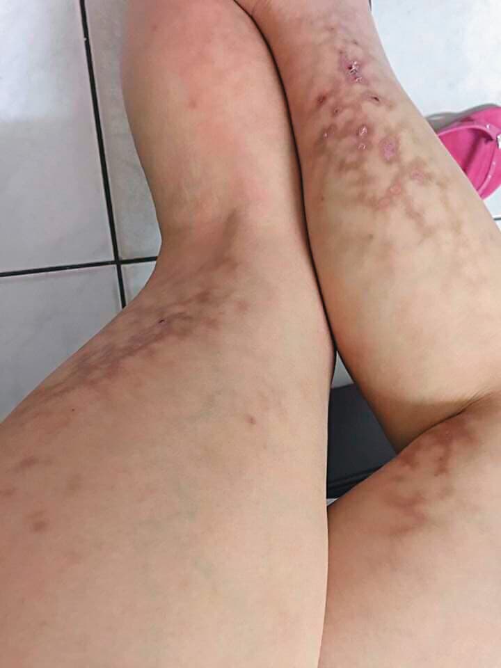 懷孕時,小雯不幸罹患妊娠高血壓,全身從臉到腳都布滿青斑。(讀者提供)
