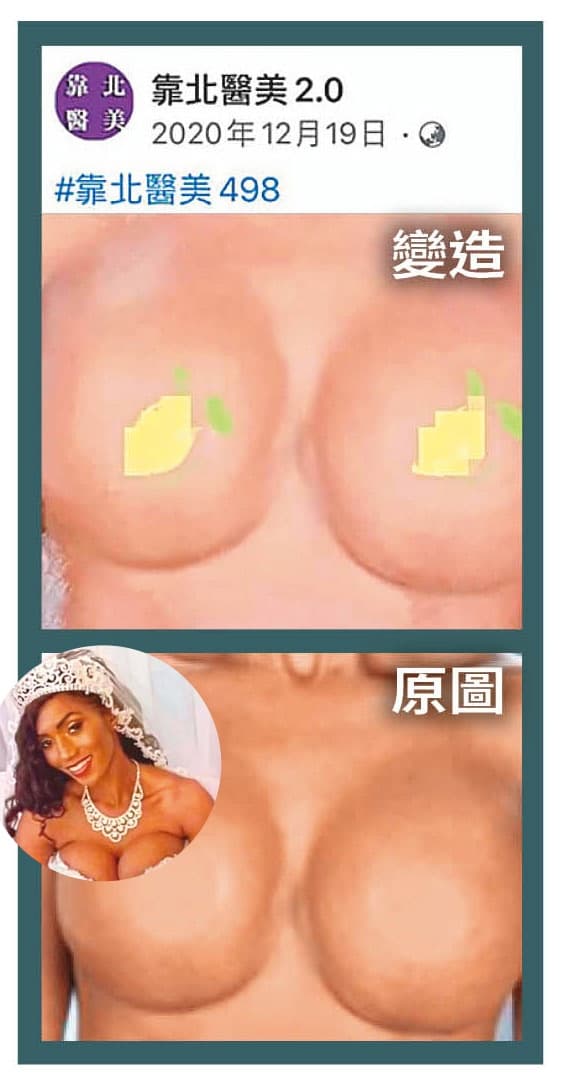 靠北醫美2.0曾貼出隆乳手術失敗照(上圖)指控A醫師,結果經過比對,該照片原圖竟是國外一則新聞照片(下圖),遭刻意刷白移花接木。(翻攝自靠北醫美2.0臉書)