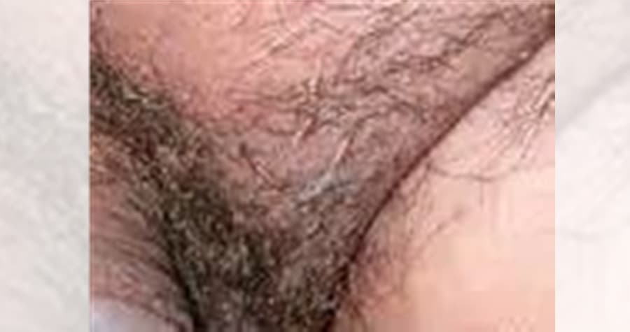 陰蝨常寄生於陰部,並邊吸血邊排糞,且幼蟲和蟲卵還會發生在毛囊的根部。(示意圖,翻攝自baidu.hk)