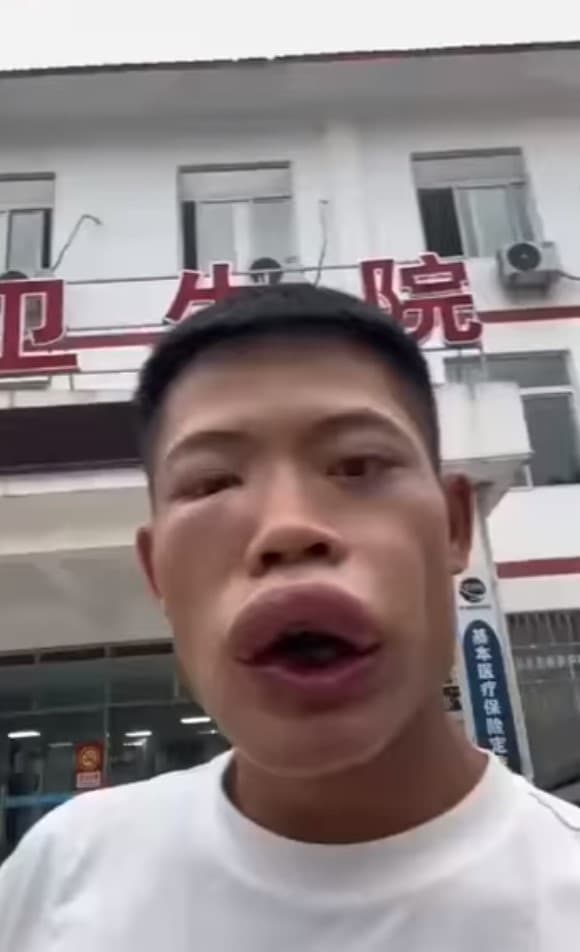 原本眉清目秀的王燦臉部腫到變形。(翻攝自抖音)