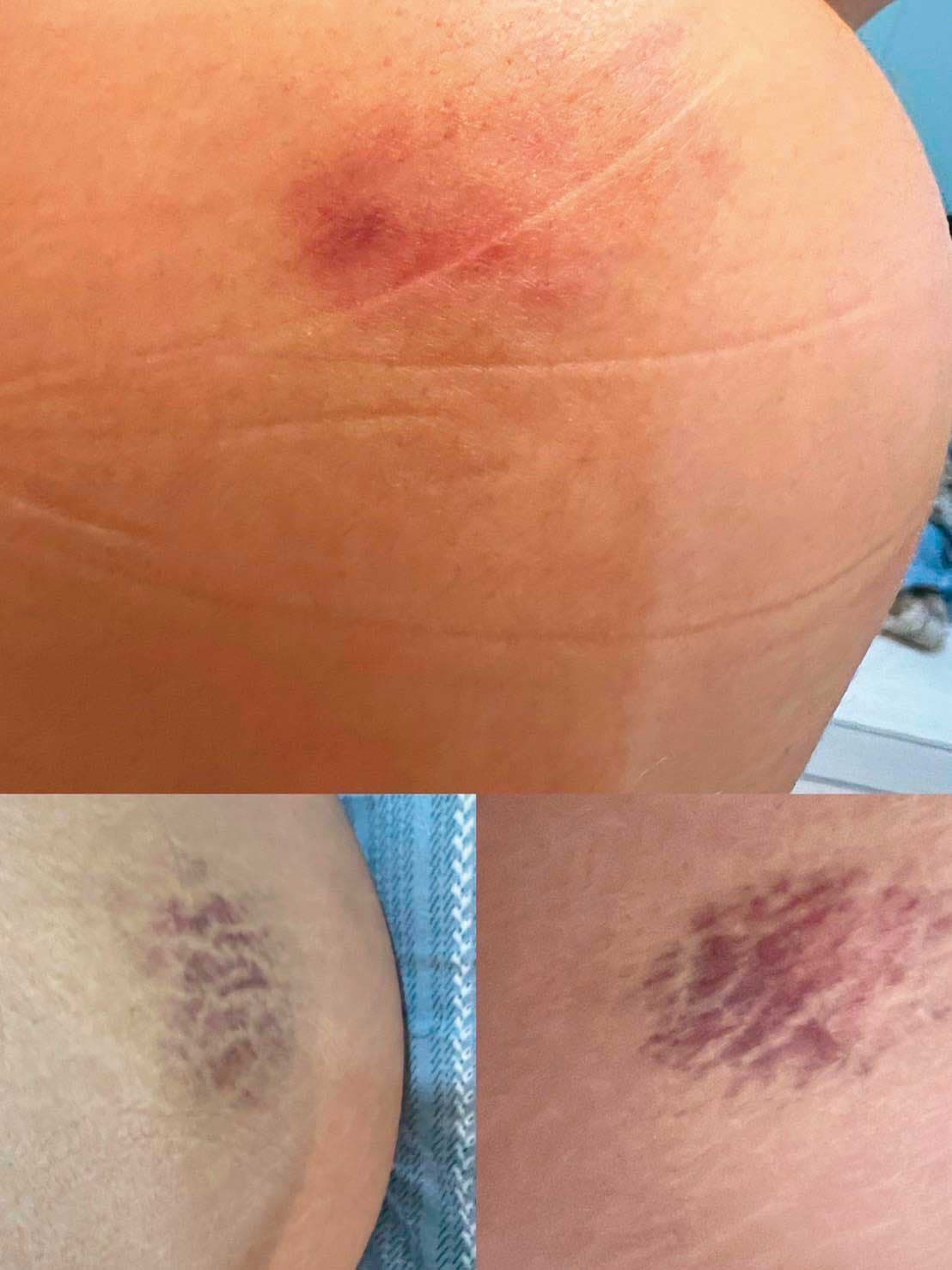 林妻的女性友人遭林其緯推打,全身多處擦挫傷。(讀者提供)