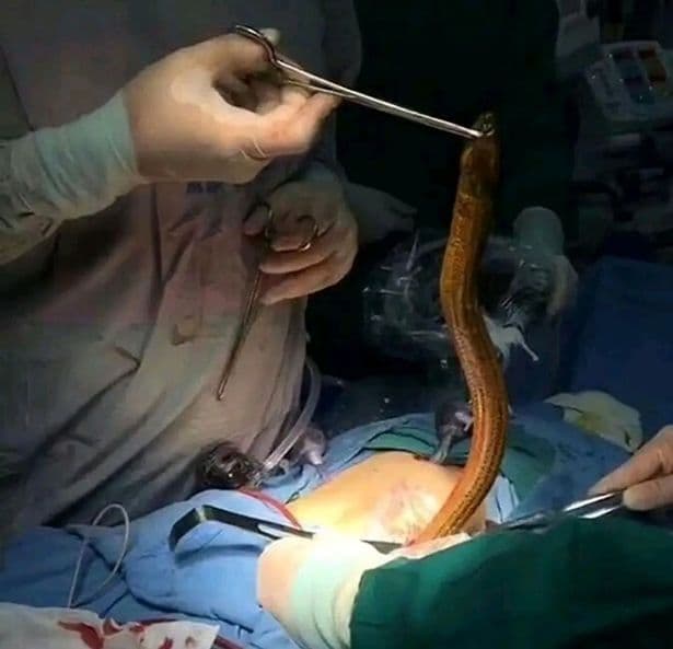 男子相信偏方,「鰻魚插肛」治便祕結果悲劇了。(翻自《每日星報》)