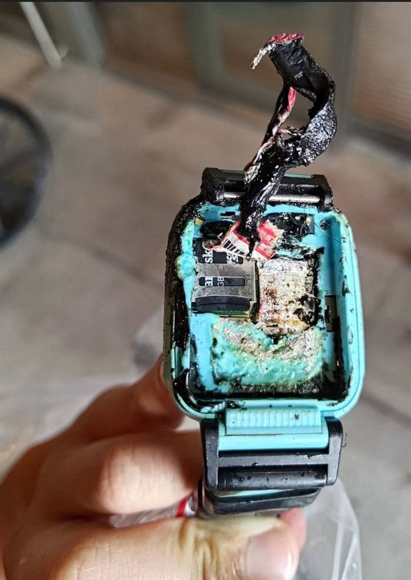 10歲男童戴在手上的智慧手錶突然爆炸燃燒,致其雙手燒燙傷。(翻攝畫面)