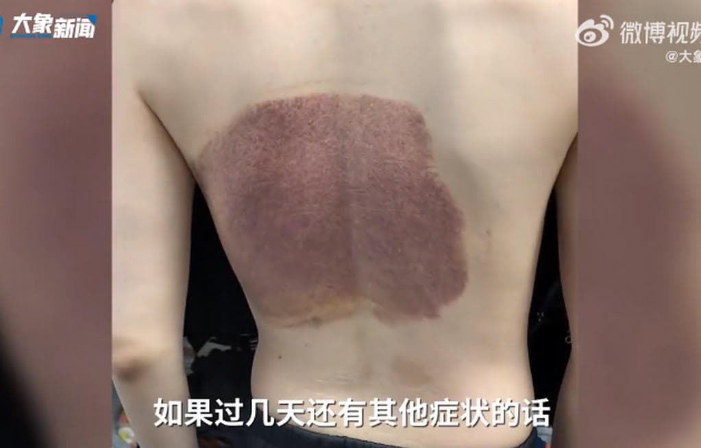 哈爾濱一名男大生在澡堂泡澡被排水口吸住,背部有大片瘀血。(翻攝微博)