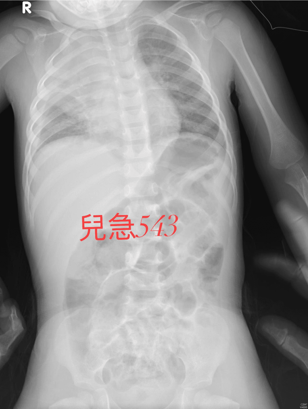 吳昌騰指出許多小孩感染呼吸道融合病毒後,併發肺炎。(翻攝臉書粉專「來講兒科急診的543-吳昌騰醫師」)