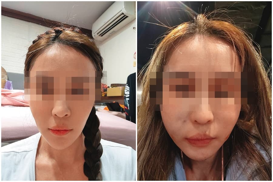 診所老客戶C小姐去年底進廠維修,沒想到手術失敗,術後整張臉腫到像豬頭,讓C小姐痛不欲生。(讀者提供)