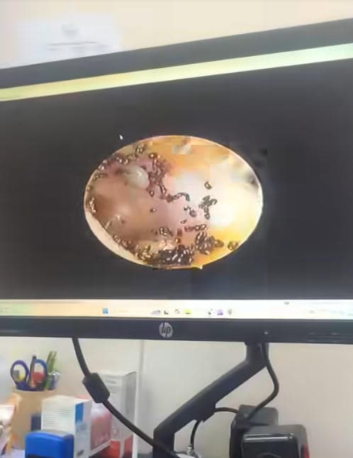 女童耳內可見密密麻麻的跳蚤寄生,畫面十分噁心。(翻攝臉書@Aqila Nasir)